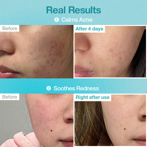 No.1 Pantothenic B5 Hyaluronic Active Clear Mask - Zklidňující plátýnková maska pro aknózní pleť 26ml