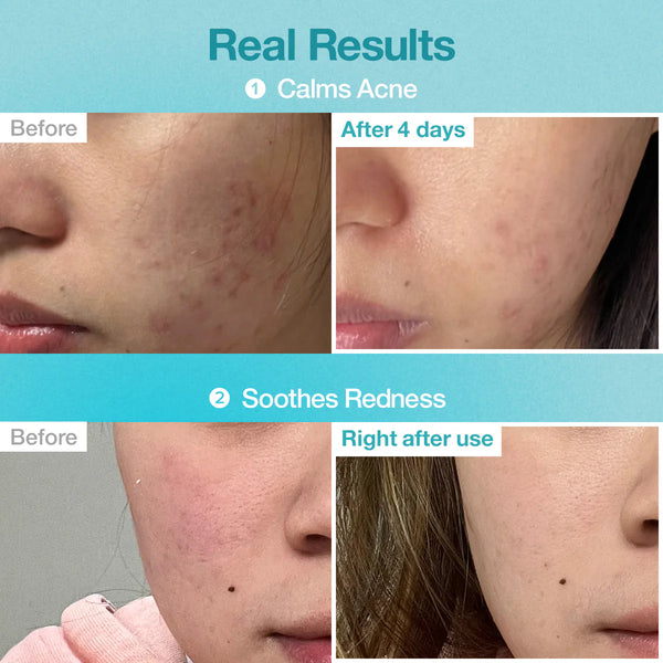 No.1 Pantothenic B5 Hyaluronic Active Clear Mask - Zklidňující plátýnková maska pro aknózní pleť 26ml