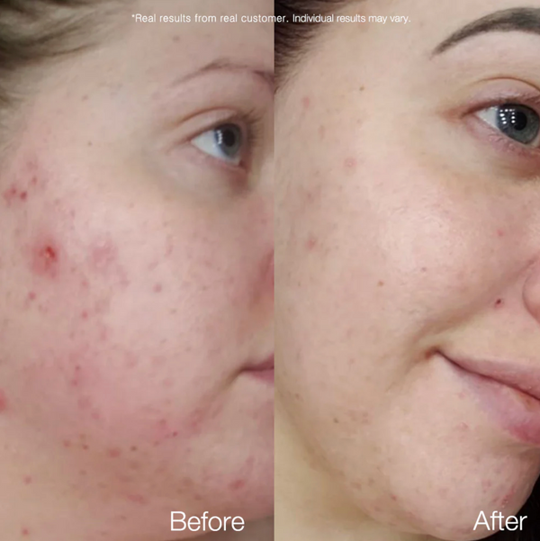 Carrotene Clarifying Serum - Sérum pro mastnou a aknózní pleť 37ml